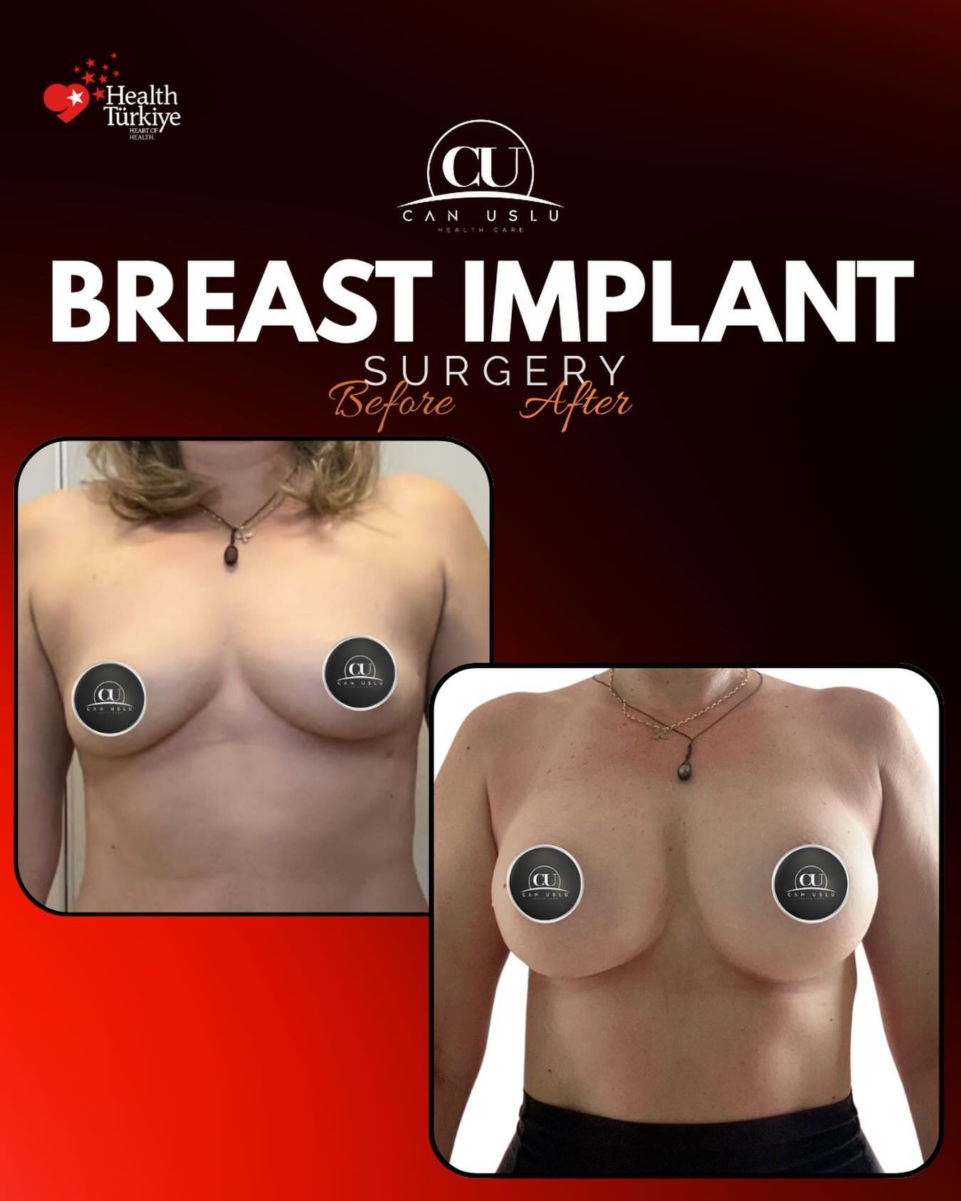 Breast Aesthetics before/after