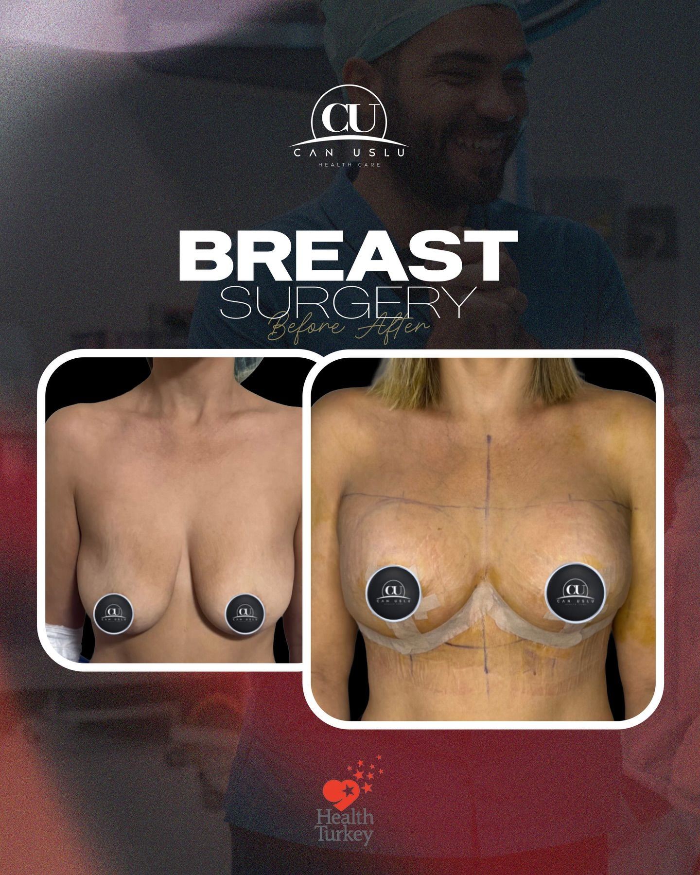 Breast Aesthetics before/after