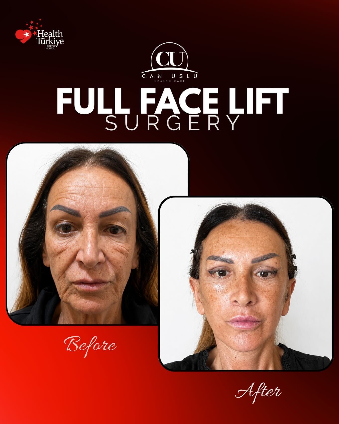 Deep Plane Facelift before/after