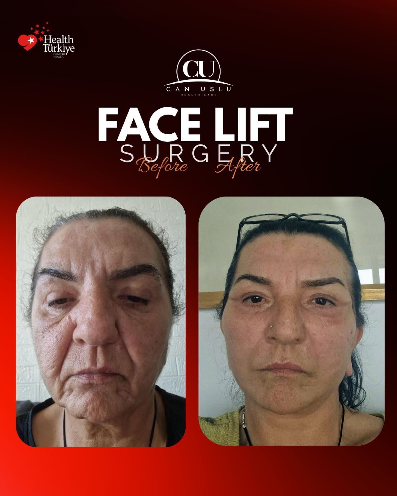 Deep Plane Facelift before/after