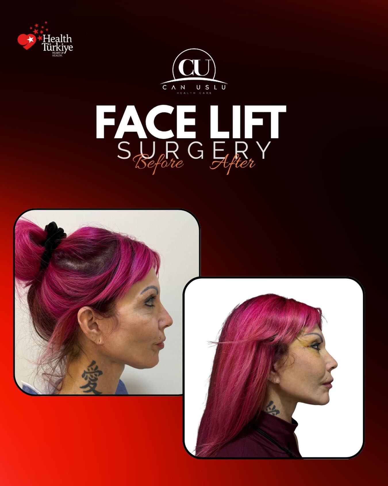 Deep Plane Facelift before/after