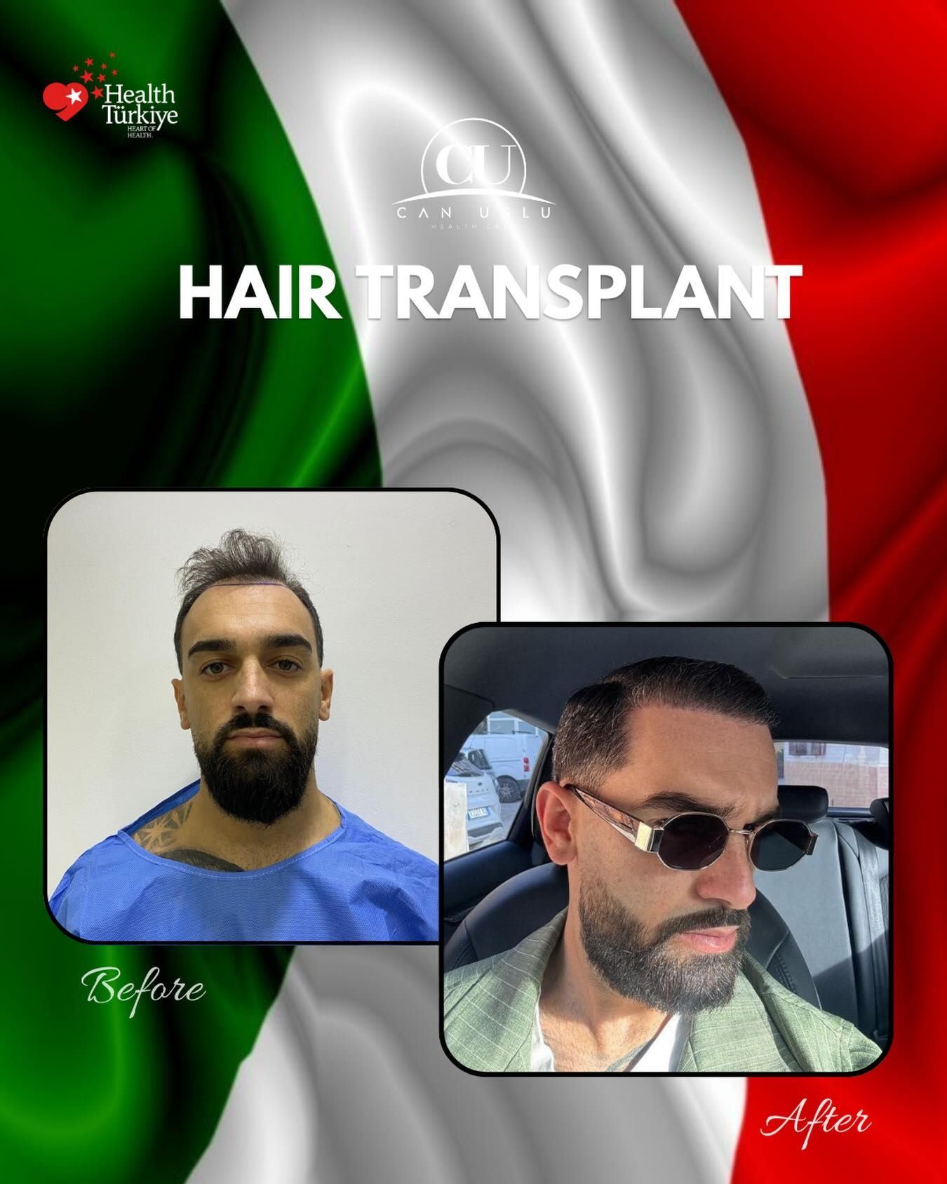 Hair Transplant before/after