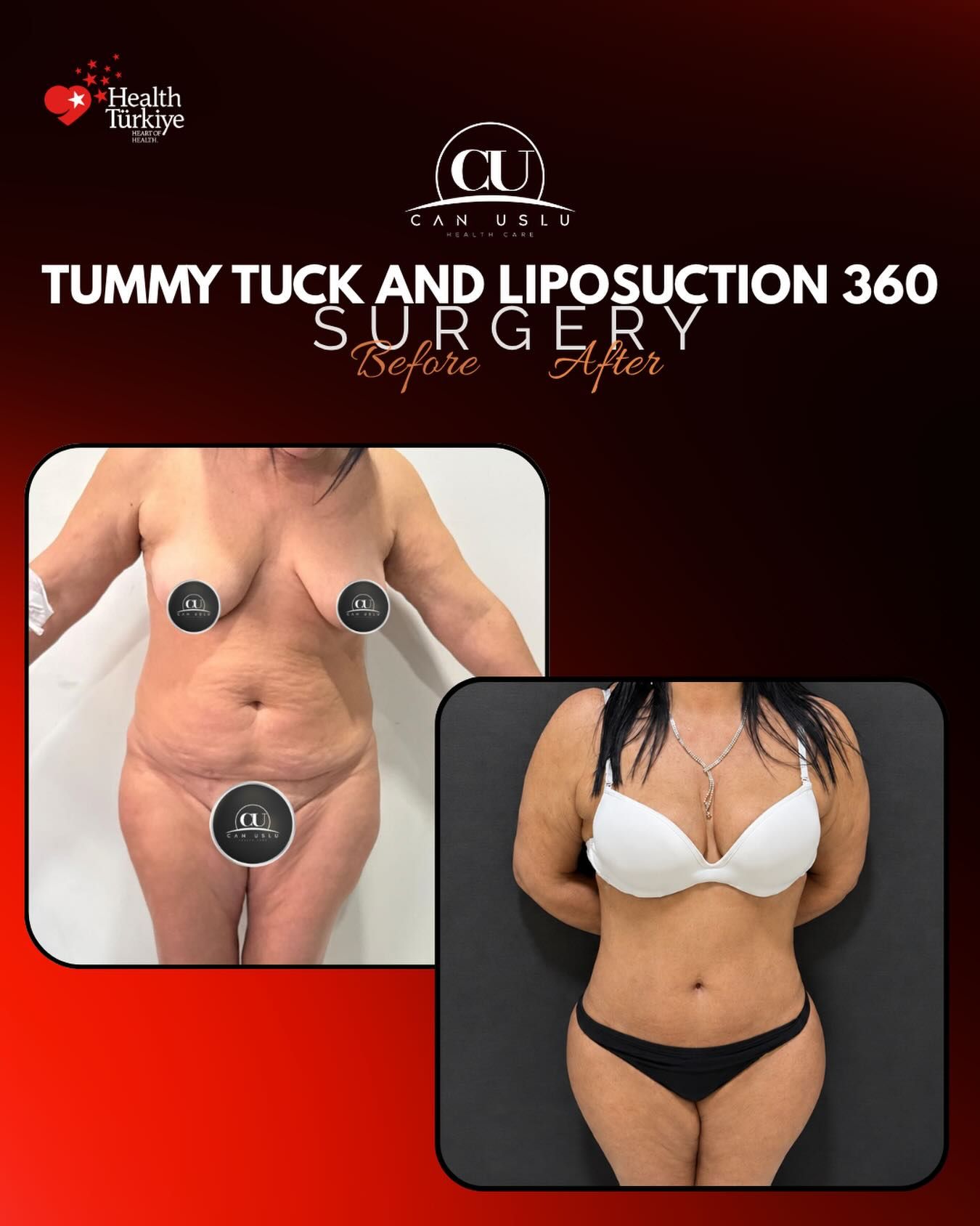 Liposuction before/after