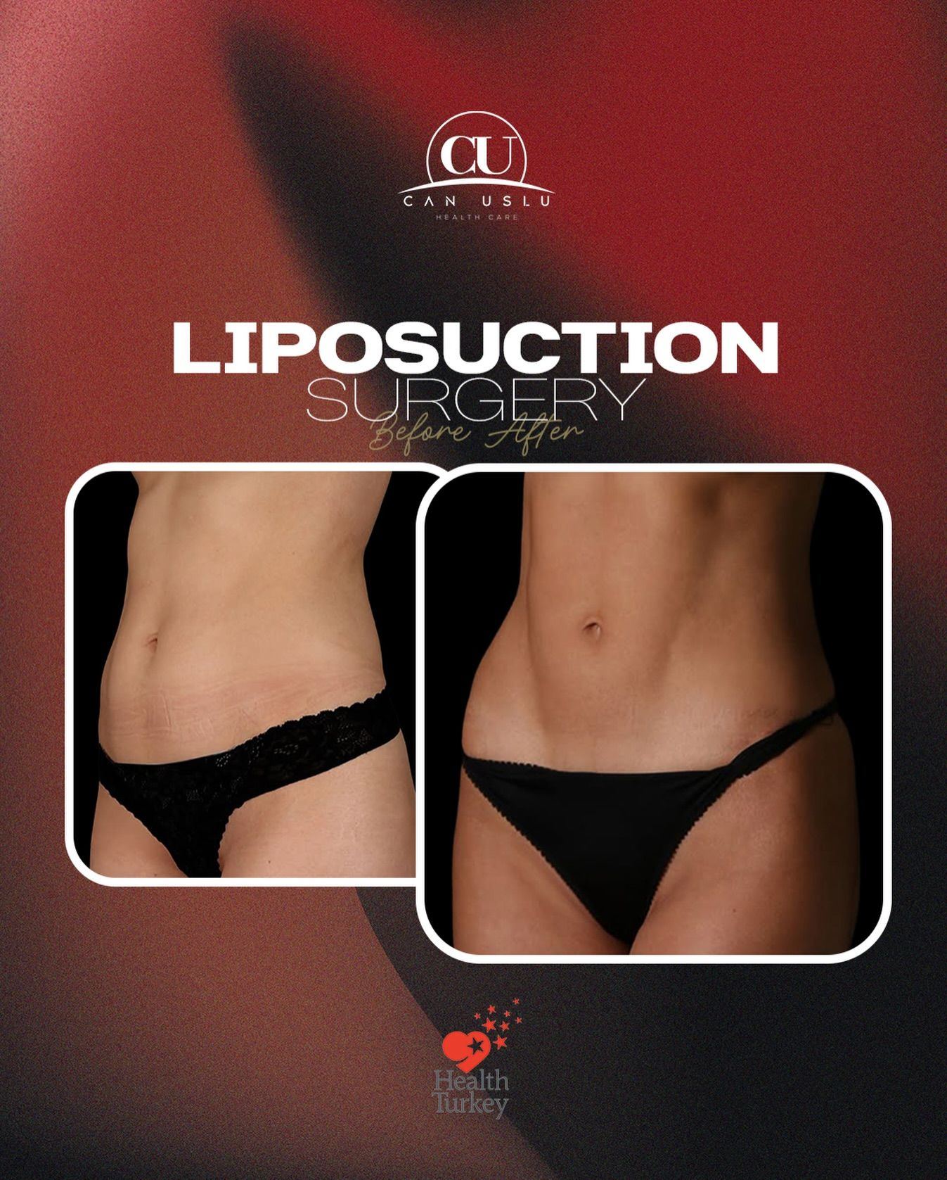 Liposuction before/after