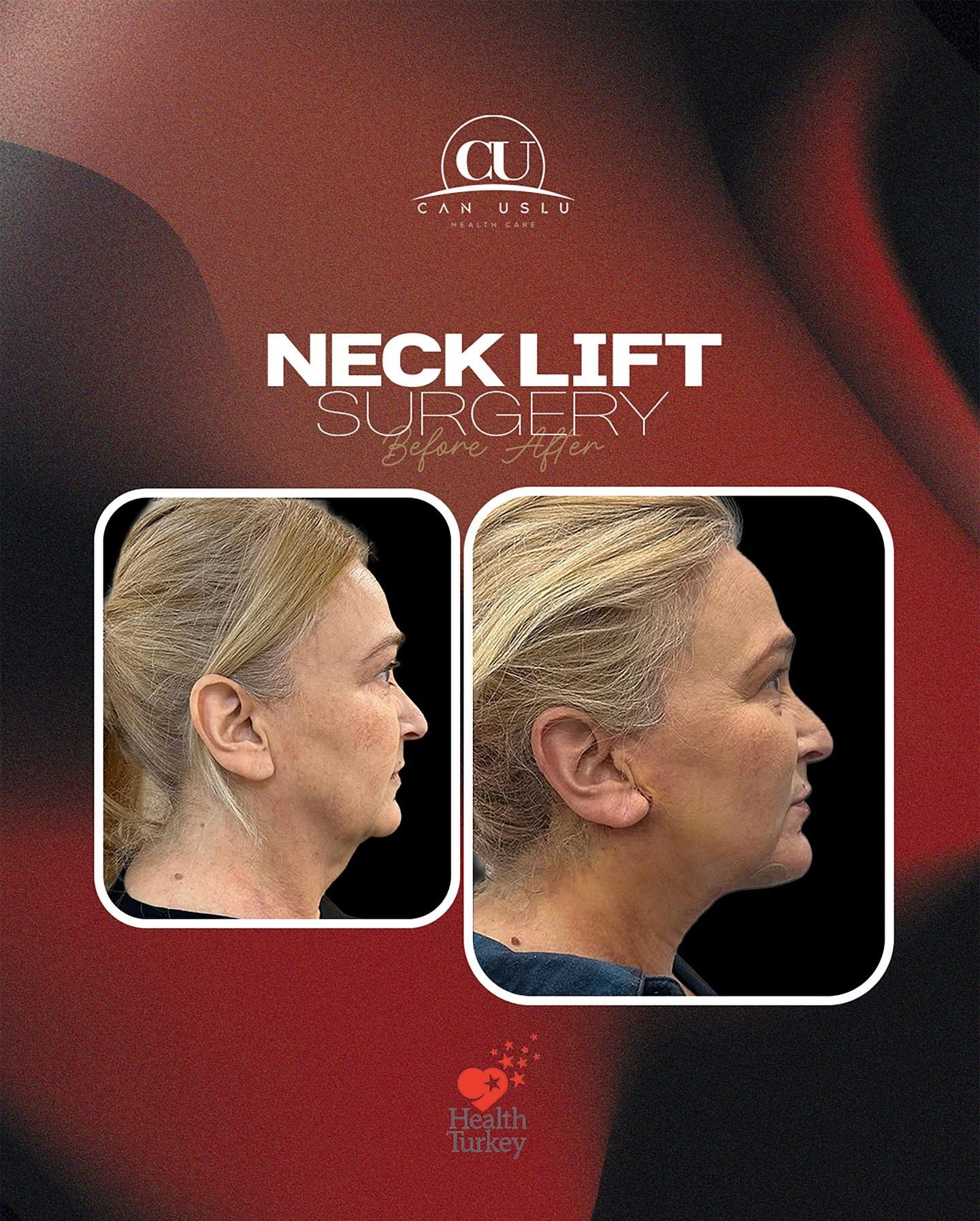 Neck Lift before/after