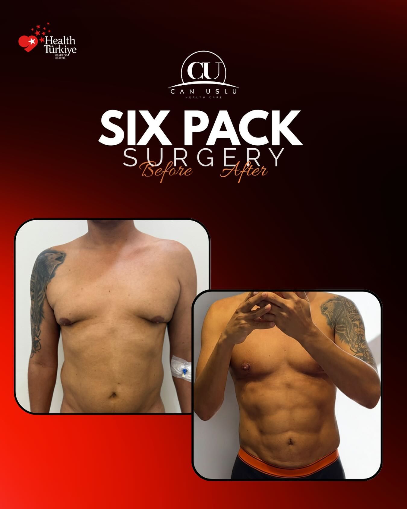 Liposuction · Sixpack before/after